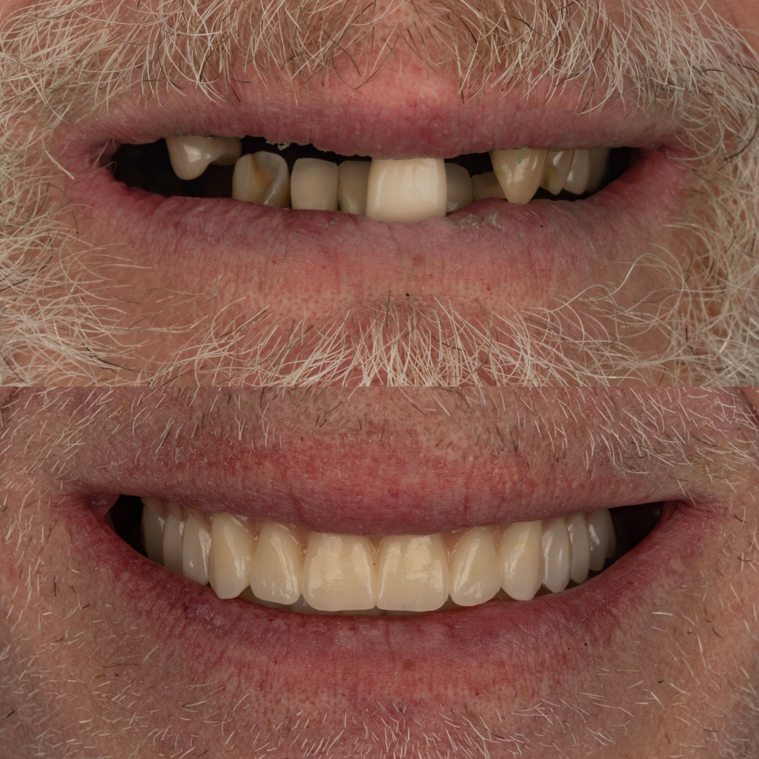 Before and after upper arch bridge restoration